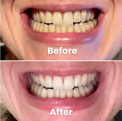 Smart Smile™ Teeth Whitening Powder